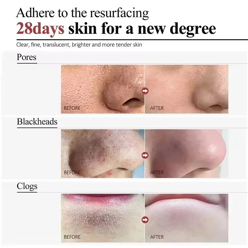 Salicylic Acid Pore Shrinking Cream Eliminate Large Pores Serum Remove Blackhead Acne Repairing Tightening Skin Care Cosmetics