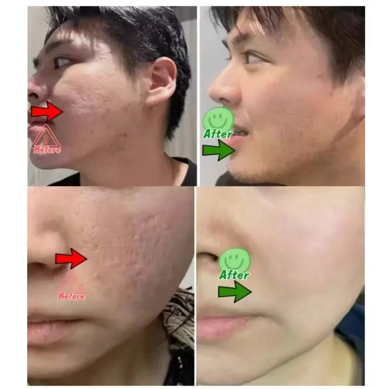 Salicylic Acid Pore Shrinking Cream Eliminate Large Pores Serum Remove Blackhead Acne Repairing Tightening Skin Care Cosmetics