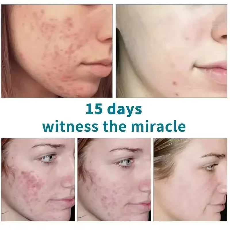 Salicylic Acid Pore Shrinking Cream Eliminate Large Pores Serum Remove Blackhead Acne Repairing Tightening Skin Care Cosmetics