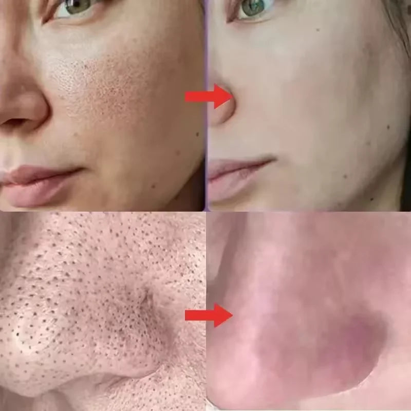 Salicylic Acid Pore Shrinking Cream Eliminate Large Pores Serum Remove Blackhead Acne Repairing Tightening Skin Care Cosmetics